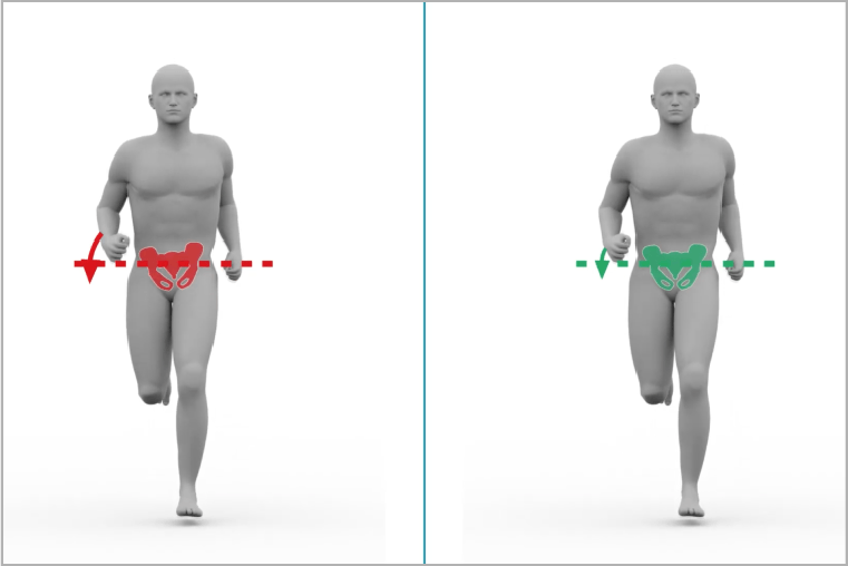 骨盤の左右傾き